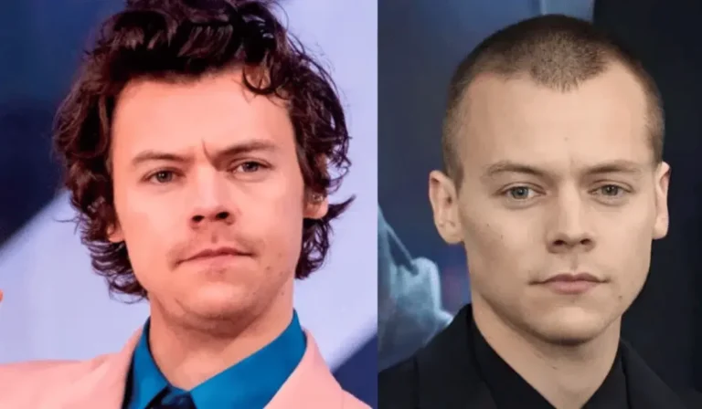 Harry Styles Hair and Hairline Review