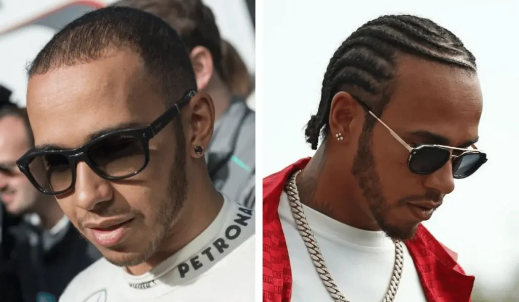 Lewis Hamilton's Hair Transplant