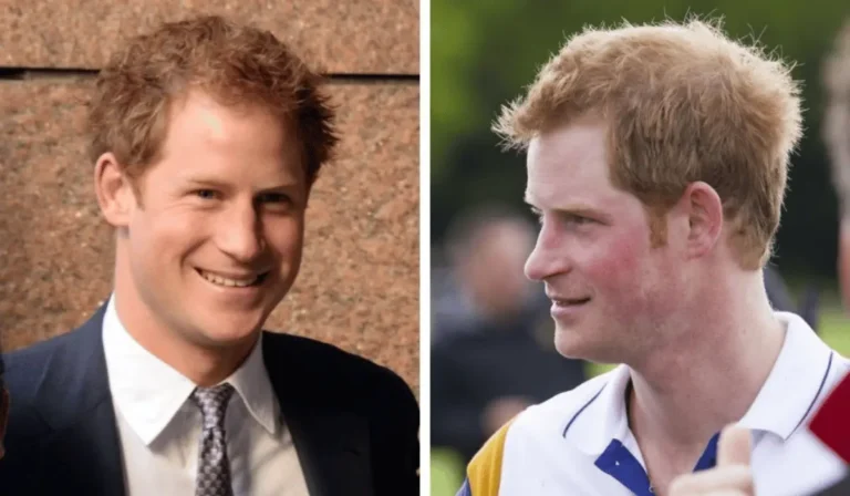 Prince Harry’s Hair Loss